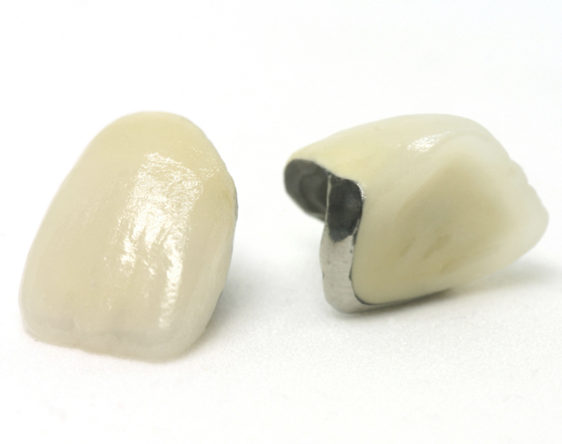 メタルボンドの画像